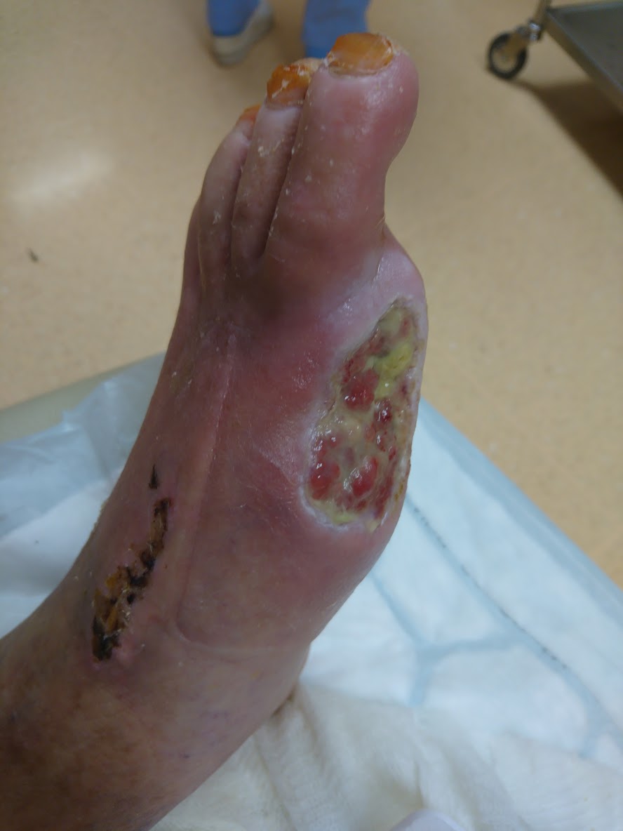 Rana po 2 mesecih po operaciji na mestu amputacije palca se lepo celi